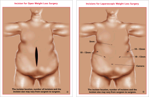 bariatric laparoscopic comparison